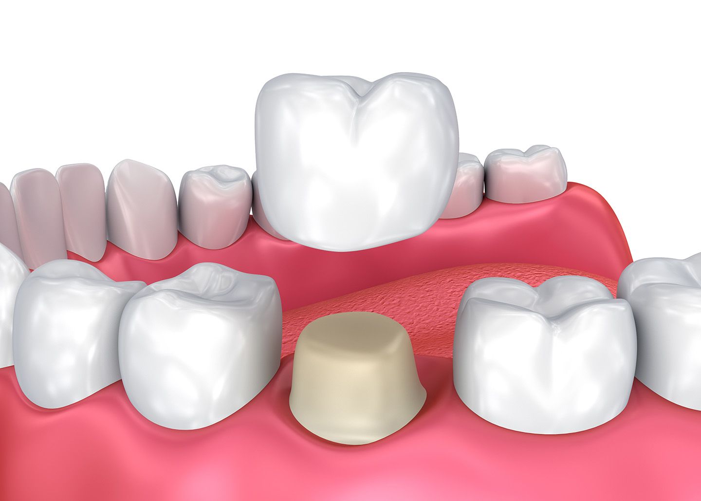Questions You Should Ask Before Getting A Dental Crown 