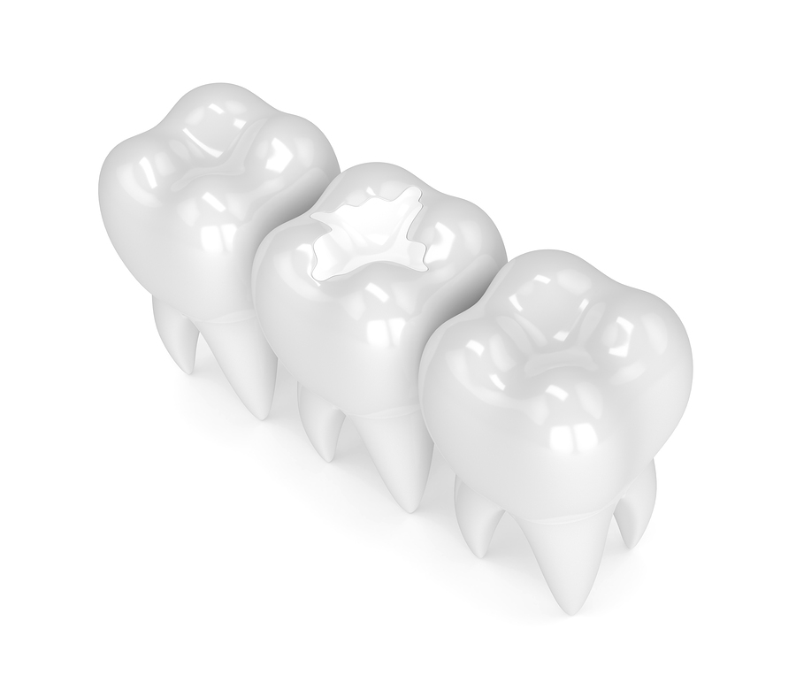 What Are the Advantages of Having White Fillings Done?