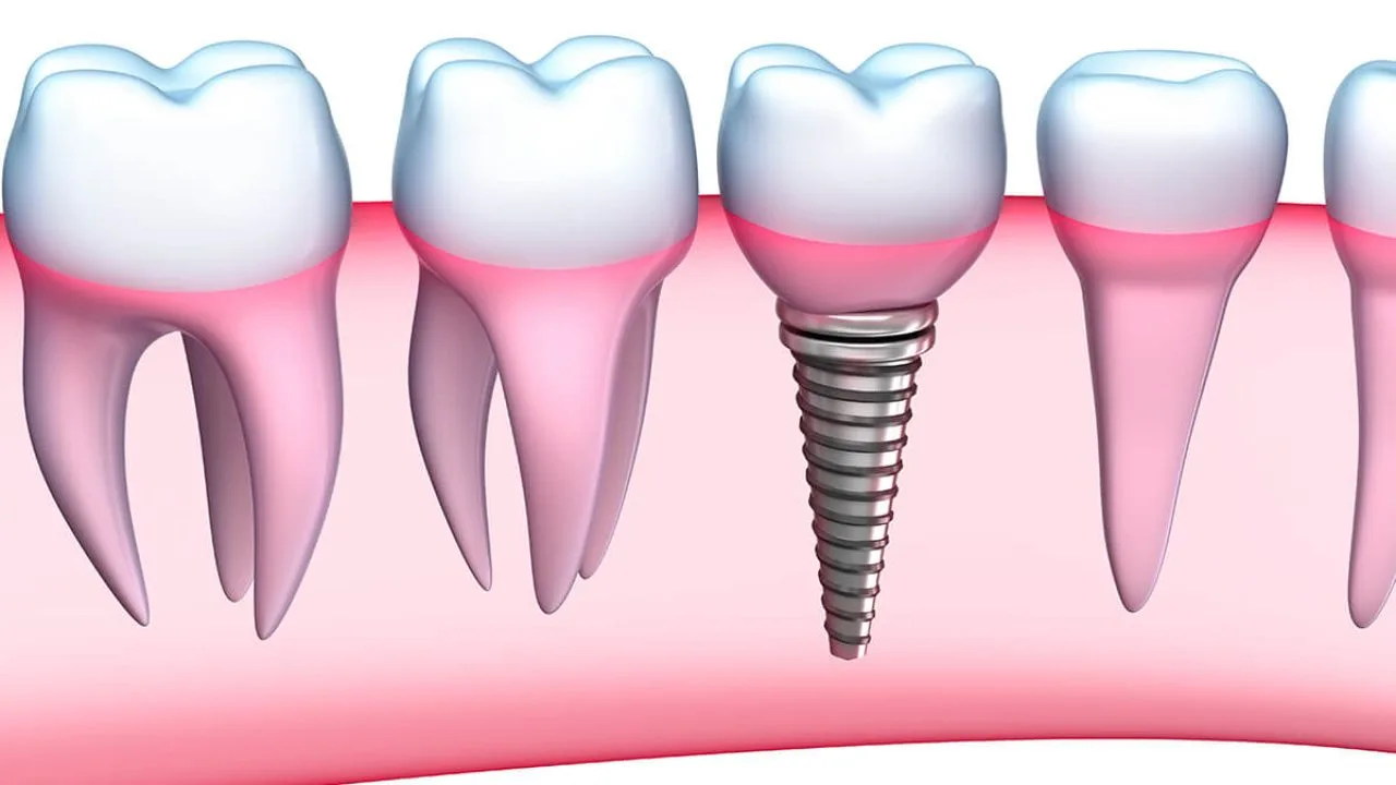 How Implants Work in Drexel Hill