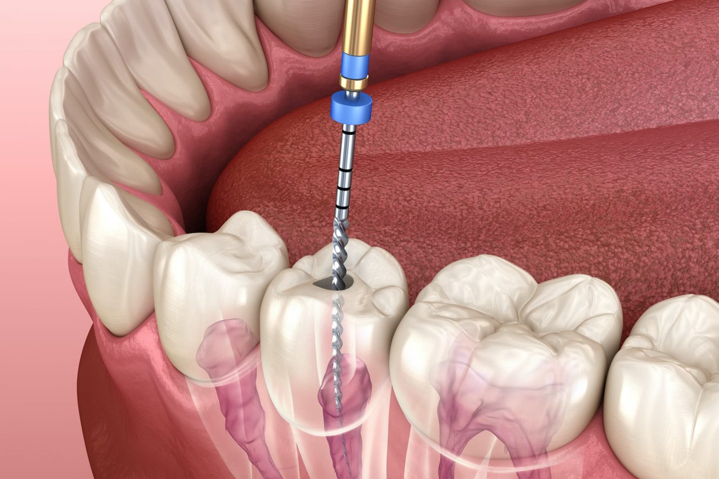 5 Reasons bridges make a sensible option in dental treatment