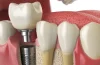 Cosmetic Dental Implant