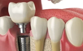 Cosmetic Dental Implant