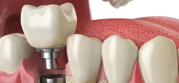 Cosmetic Dental Implant