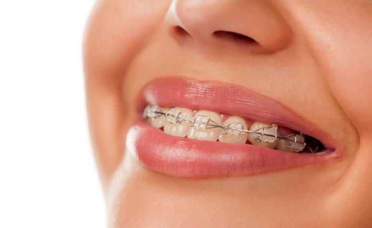Orthodontic Solutions in Calgary