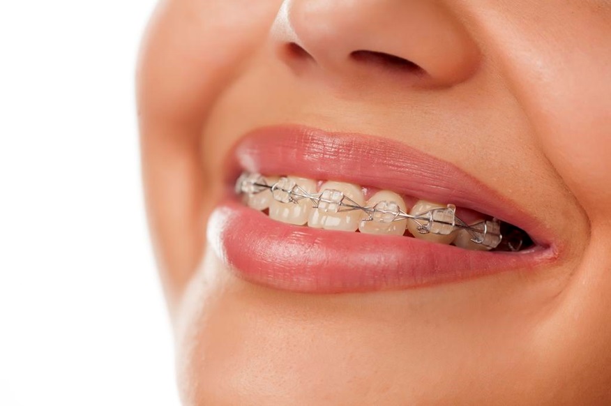 Orthodontic Solutions in Calgary Can Transform Your Smile and Oral Health