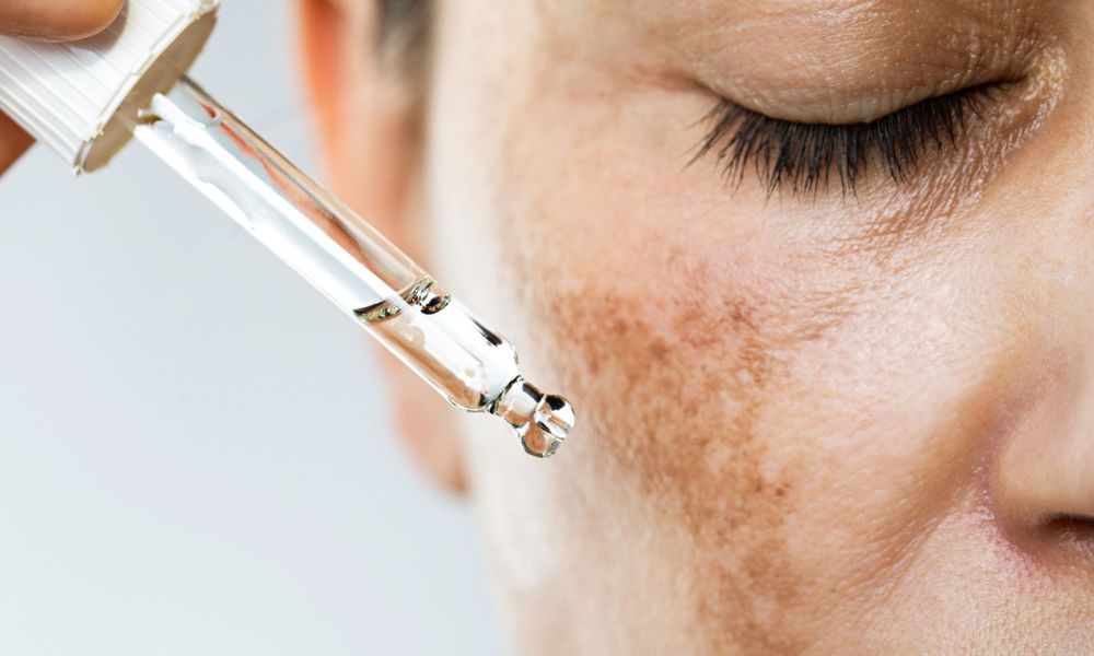 Hyperpigmentation Treatment