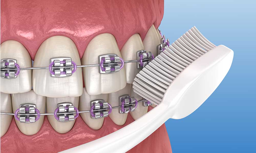 Why Orthodontic Retainers Are Important Post Braces