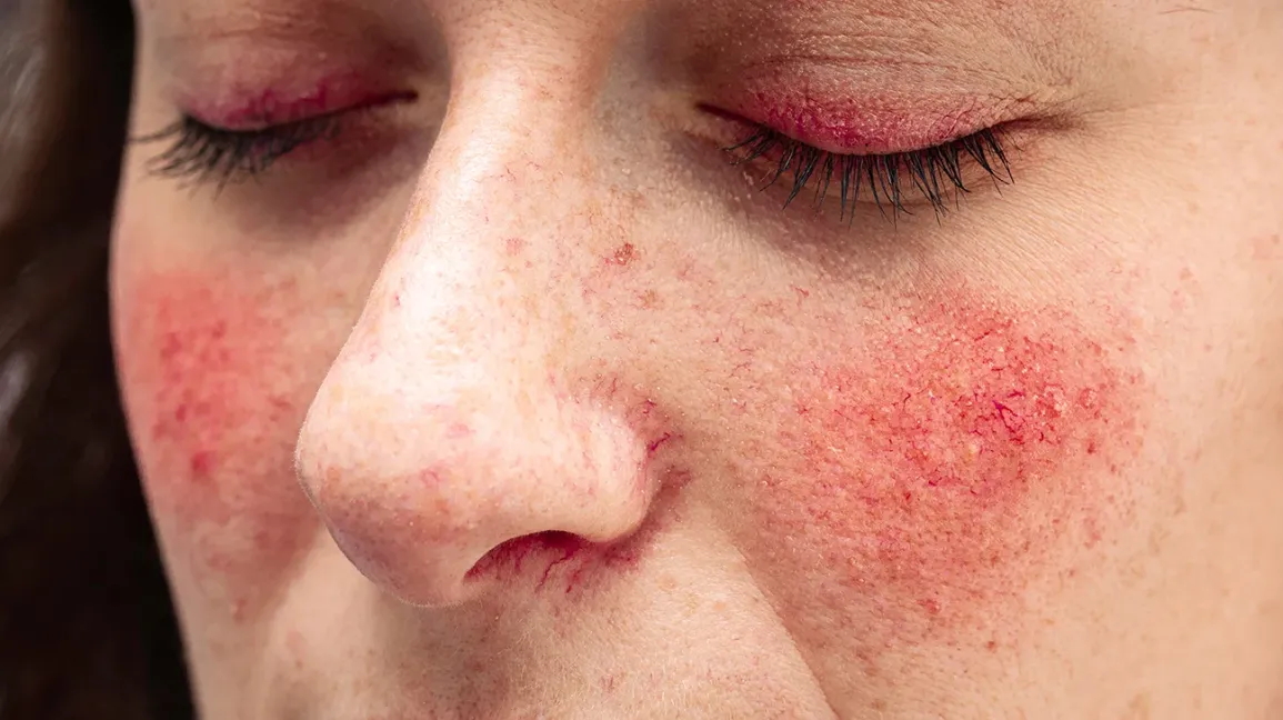 Exploring The Dermatologist’s Role In Managing Rosacea