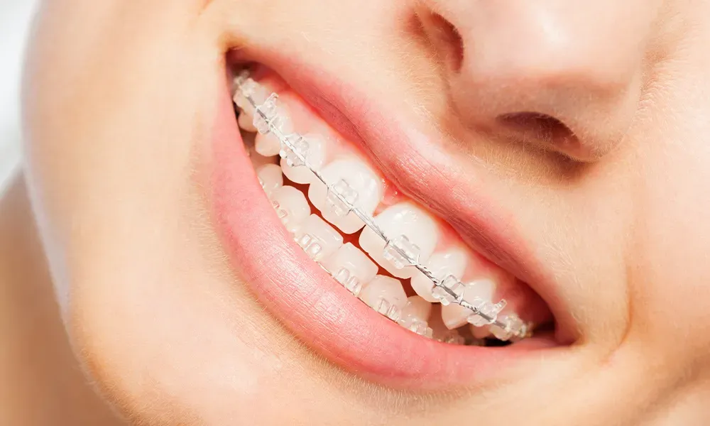 Invisalign vs. Traditional Braces: Which is Right for You?