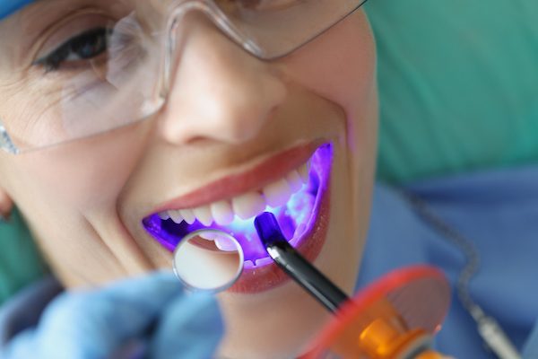 Fissure Sealant