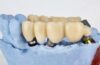 Dental Bridge