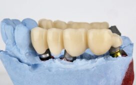Dental Bridge
