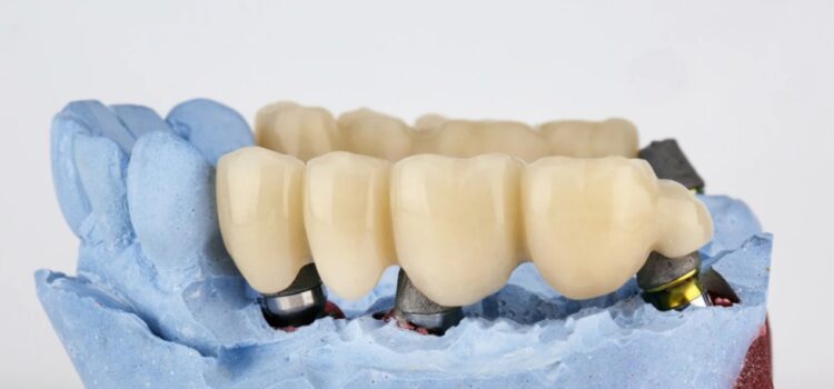 Dental Bridge