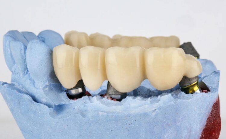 Dental Bridge