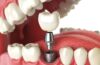 Denture Implant