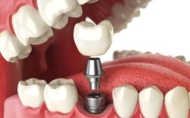 Denture Implant