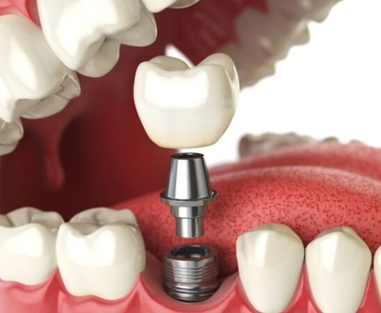 Denture Implant
