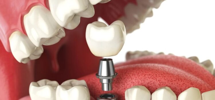 Denture Implant