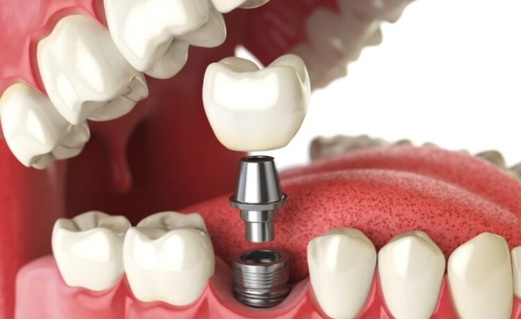 Denture Implant