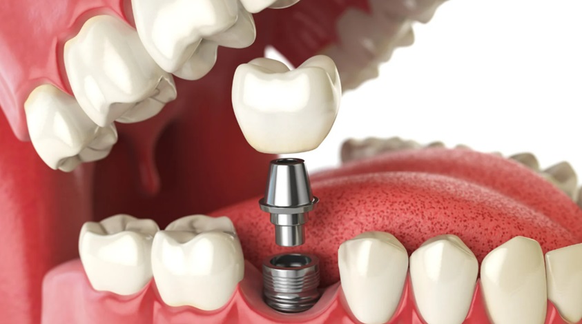A Comprehensive Guide to Choosing the Right Denture Implant