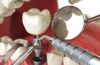 Tooth Implants