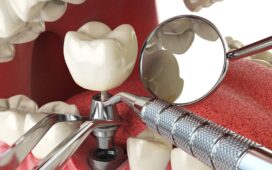 Tooth Implants