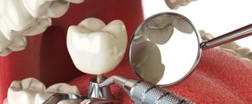 Tooth Implants