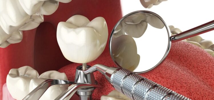 Tooth Implants
