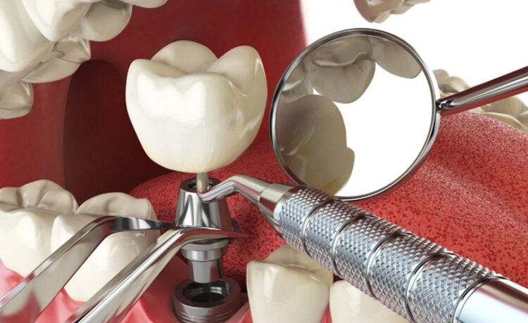 Tooth Implants