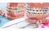types of braces
