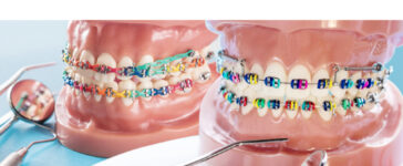 types of braces