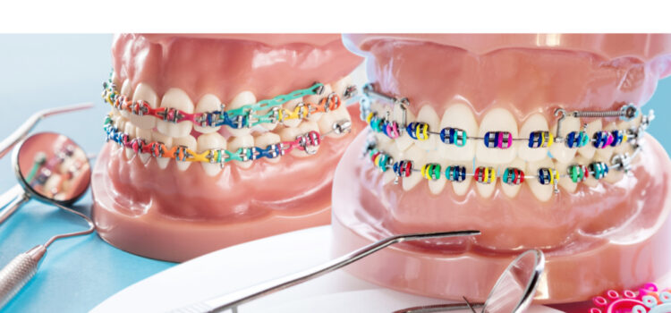 types of braces