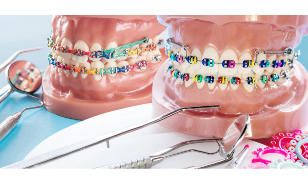 Types of Braces Explained for First-Time Dental Patients