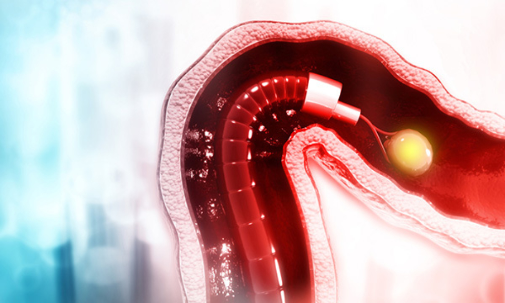 Polyp Removal During Colonoscopy: Additional Costs